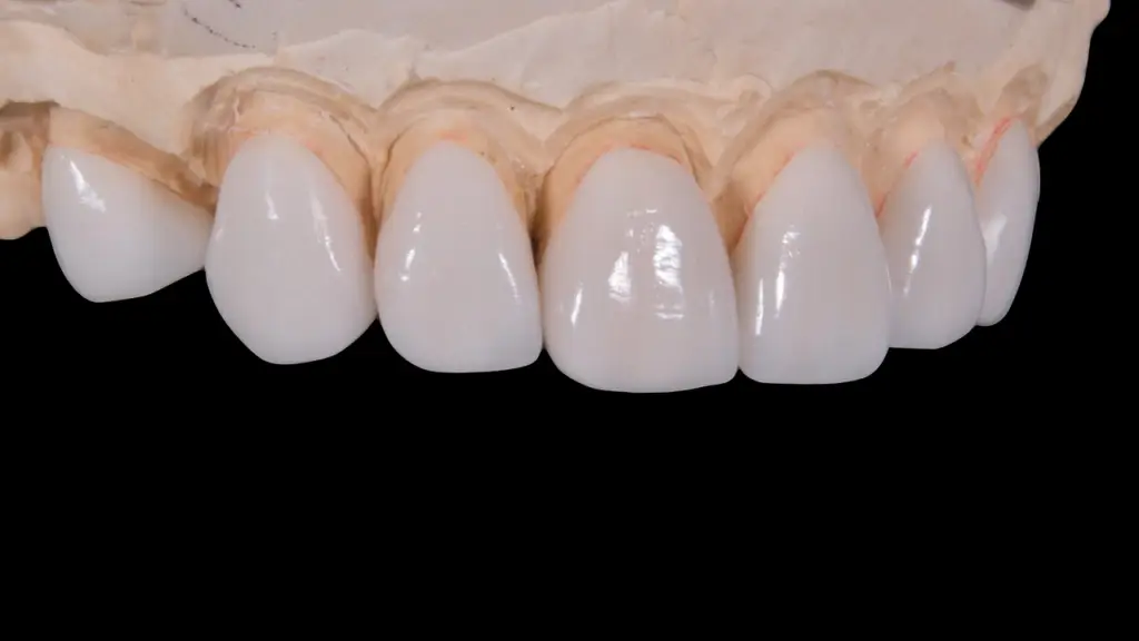 Dental model with six white crowns on front teeth