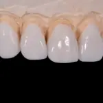 Dental model with six white crowns on front teeth