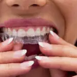 Patient placing a clear dental aligner over upper teeth