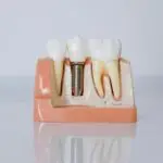 Cross-section model of a dental implant between natural teeth