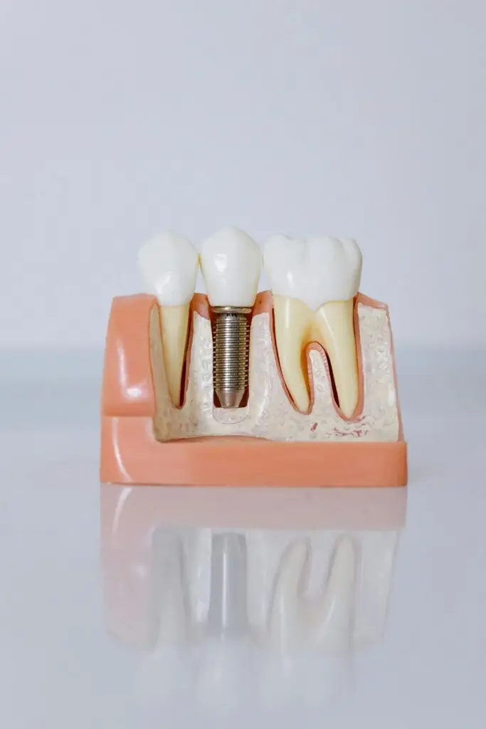 Cross-section model of a dental implant between natural teeth