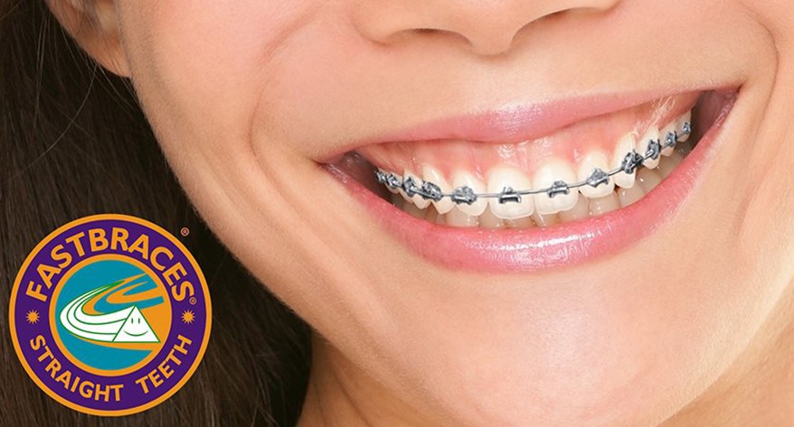 Close-up of a smiling mouth with metal dental braces on upper and lower teeth. Log on the left